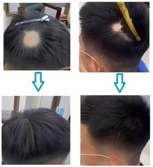 1″ Diameter Thin PU 100% Human Hair Topper Traceless Baby Hair Loss Cover 6″~8″
